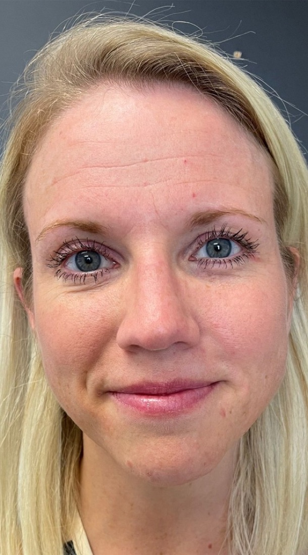 NeoMed Spa patient before treatment