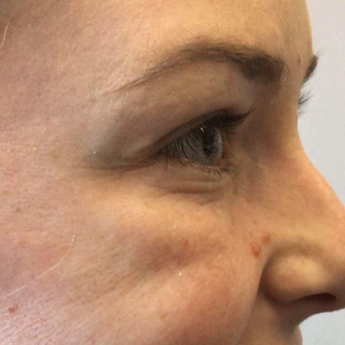 After — Crow's Feet — Botox at NeoMed Spa in Temecula, CA