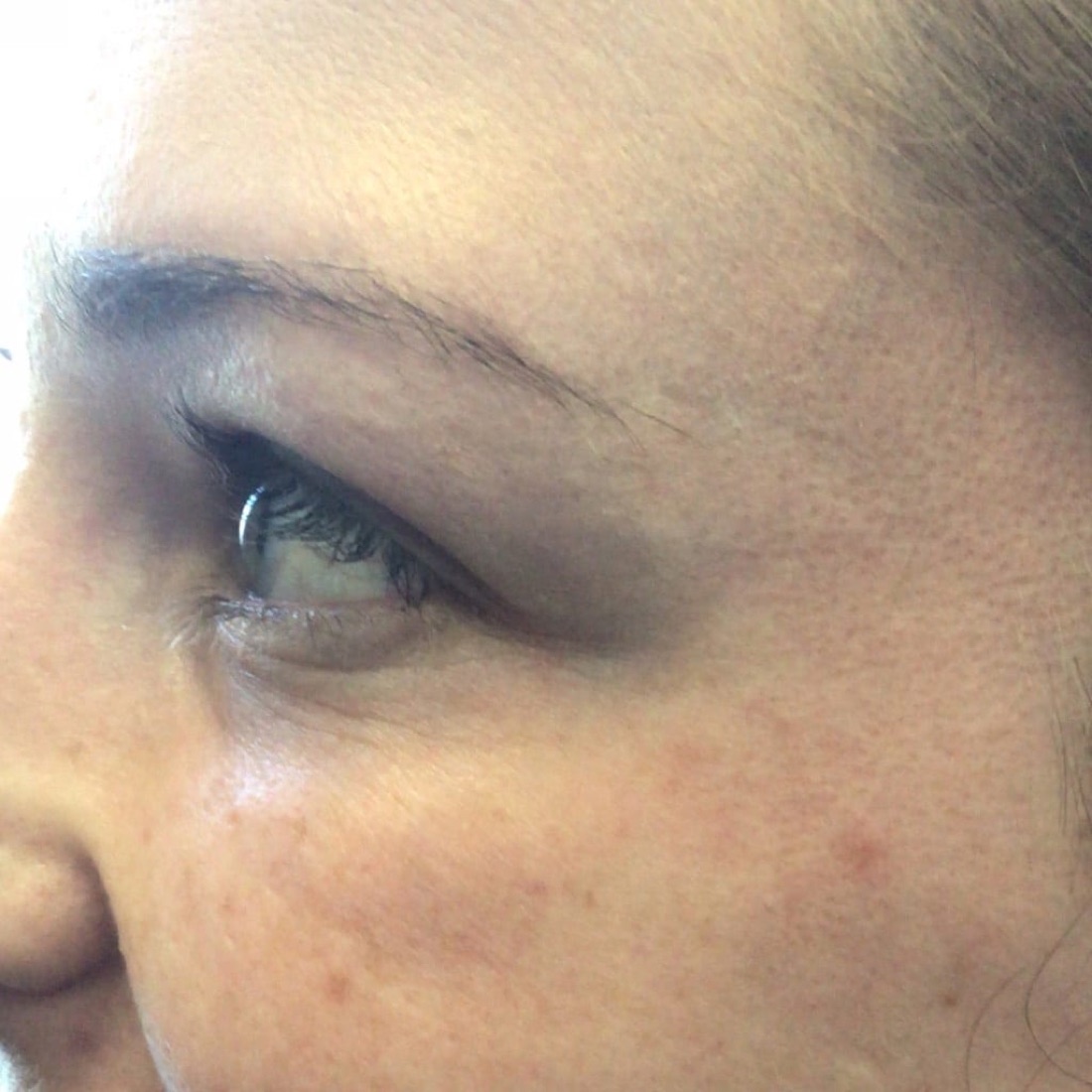 After — Crow's Feet — Botox at NeoMed Spa in Temecula, CA