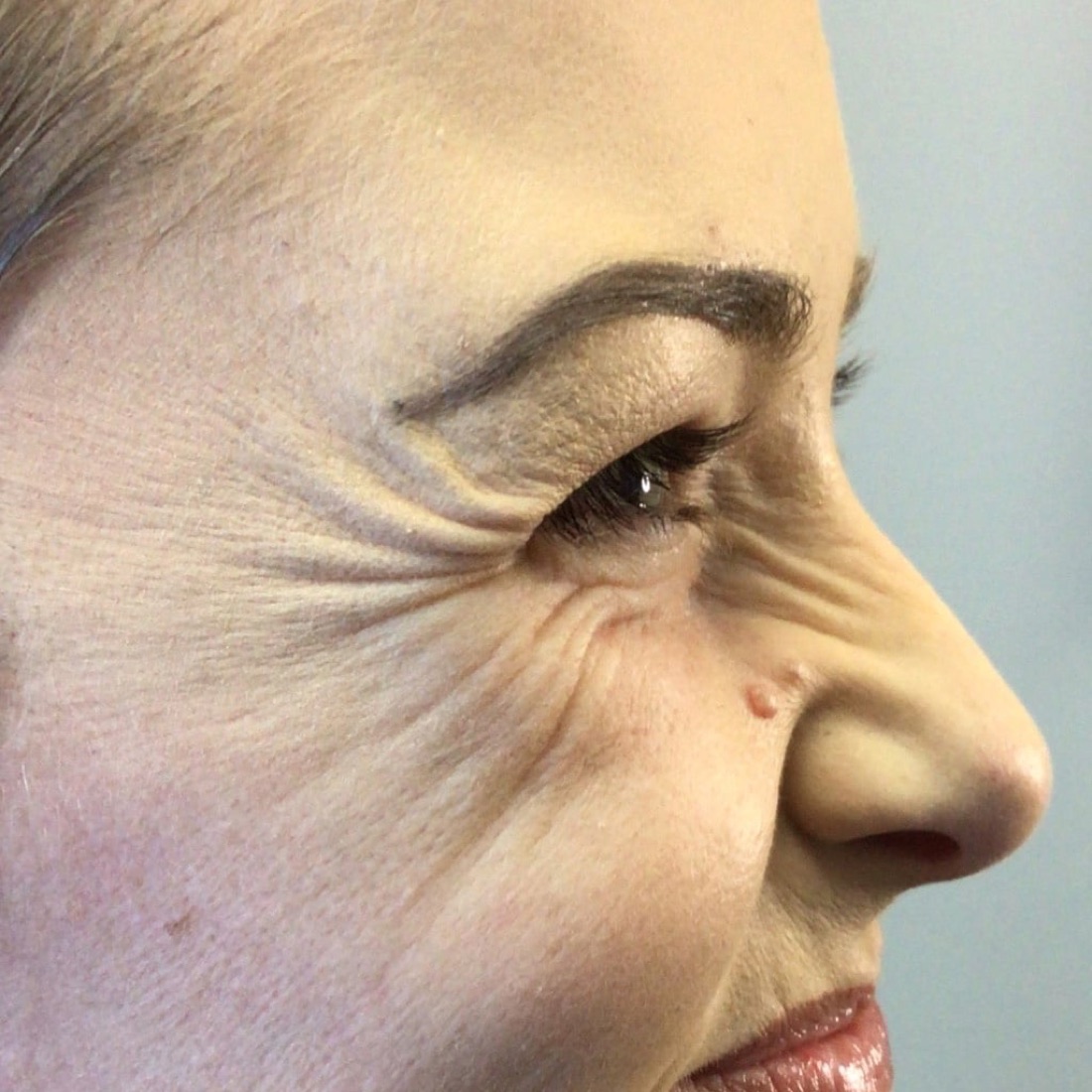 Before — Crow's Feet — Botox at NeoMed Spa in Temecula, CA