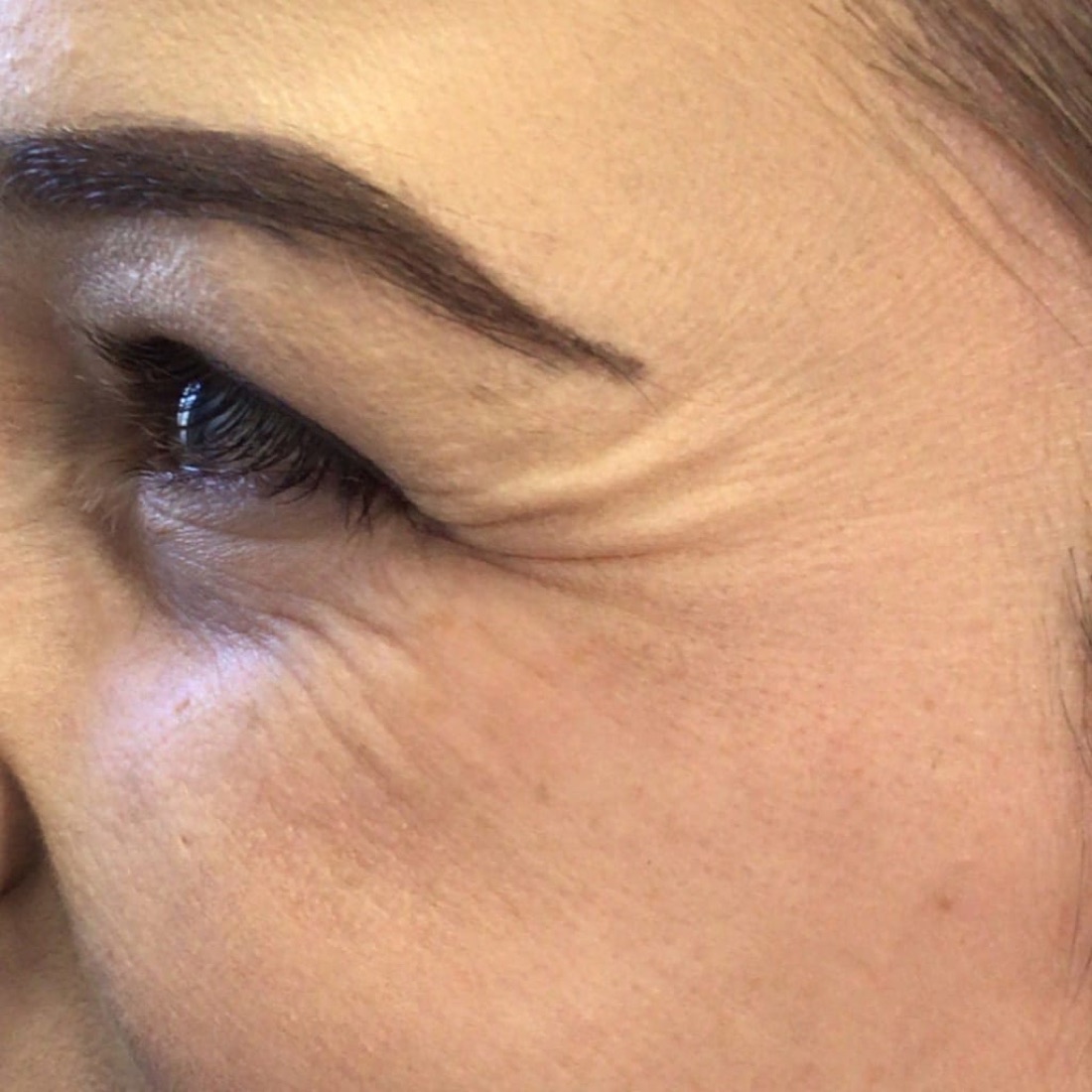 Before — Crow's Feet — Botox at NeoMed Spa in Temecula, CA