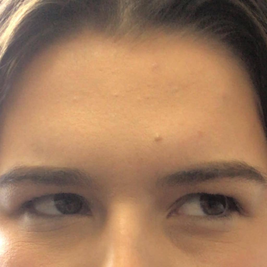 After — Frown Lines & Forehead — Botox at NeoMed Spa in Temecula, CA