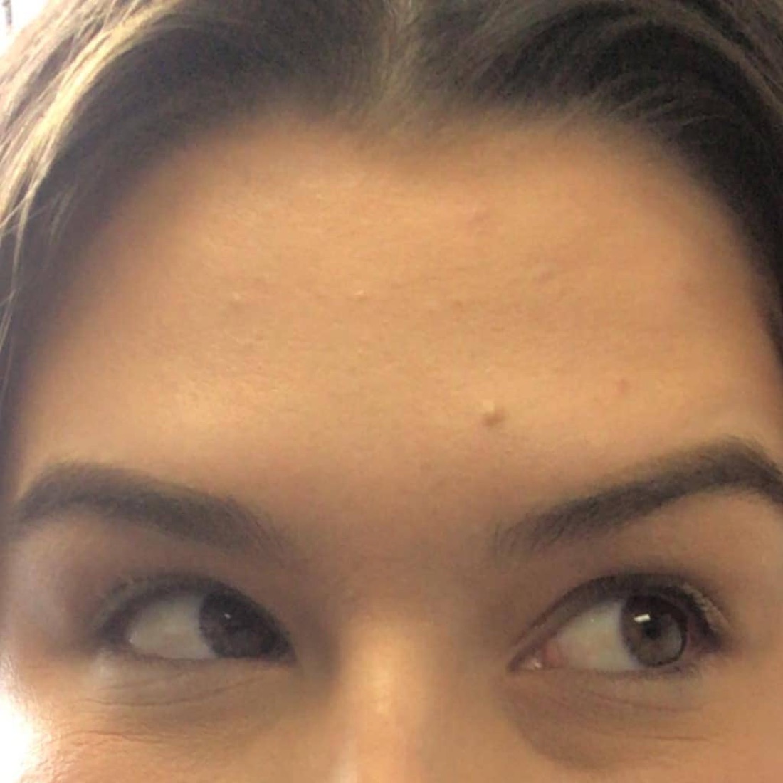 After — Frown Lines & Forehead — Botox at NeoMed Spa in Temecula, CA