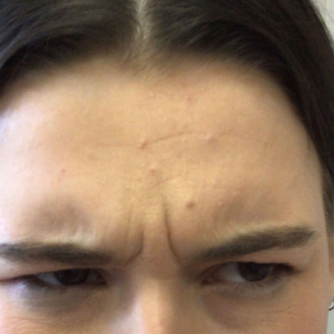 Before — Frown Lines & Forehead — Botox at NeoMed Spa in Temecula, CA