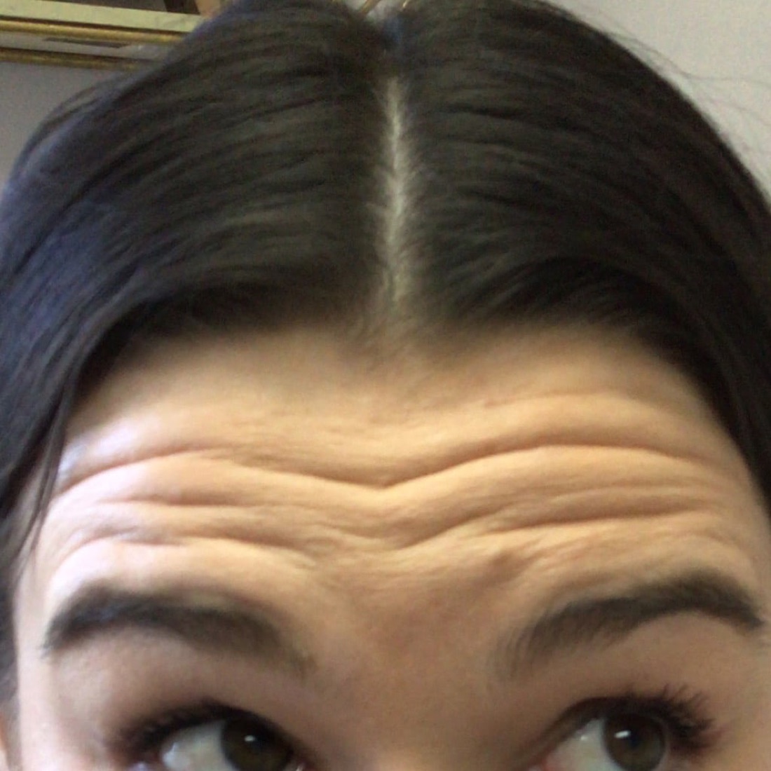 Before — Frown Lines & Forehead — Botox at NeoMed Spa in Temecula, CA