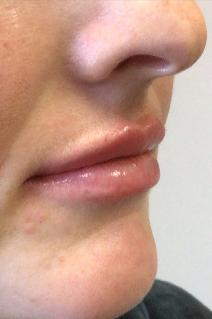 After — Lip Filler — 1 Syringe at NeoMed Spa in Temecula, CA