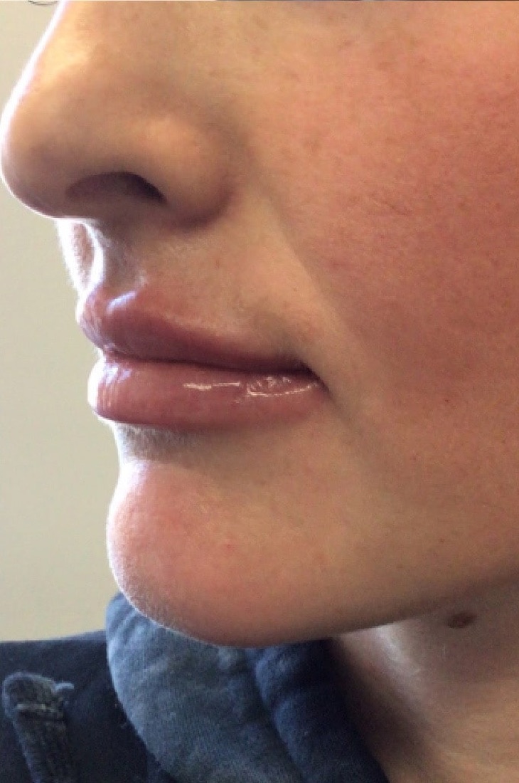 After — Lip Filler — 1 Syringe at NeoMed Spa in Temecula, CA