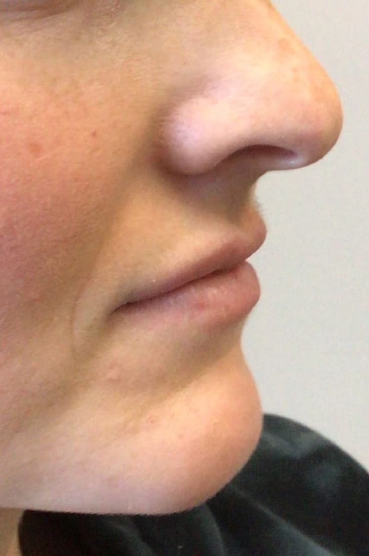 Before — Lip Filler — 1 Syringe at NeoMed Spa in Temecula, CA