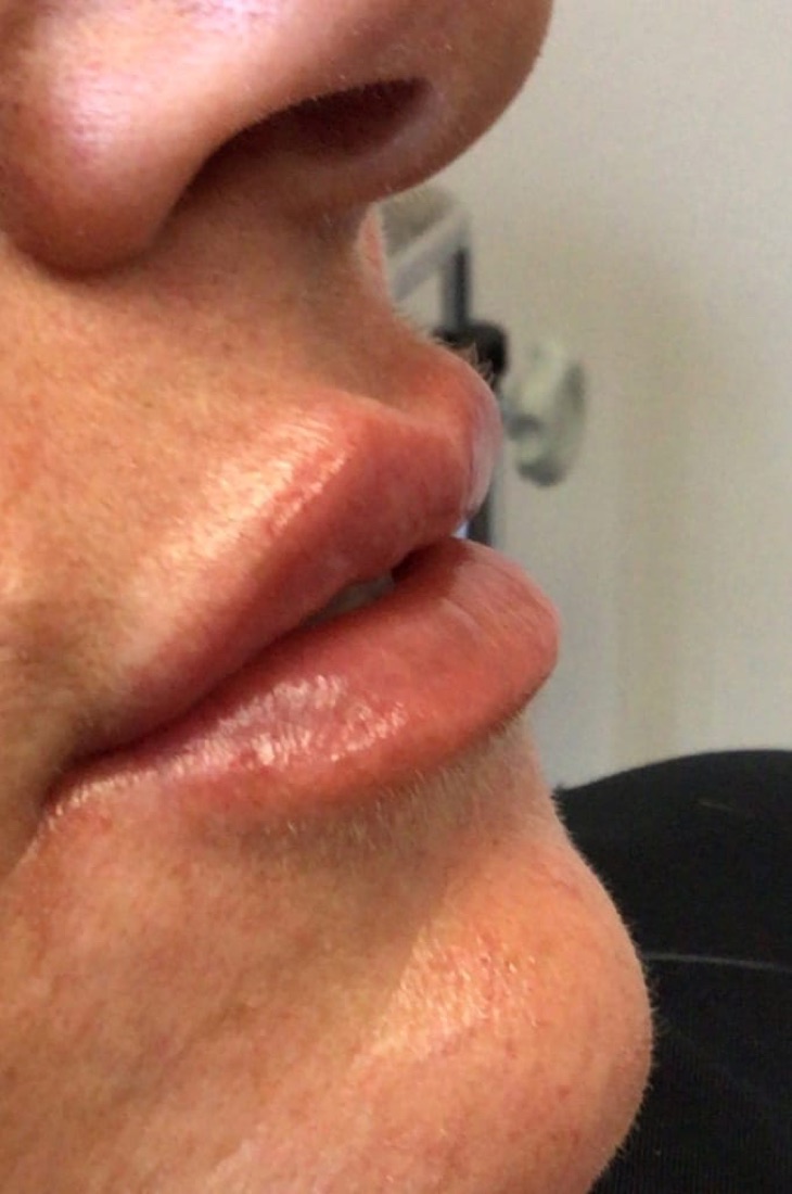 After — Lip Filler — 2 Syringes at NeoMed Spa in Temecula, CA