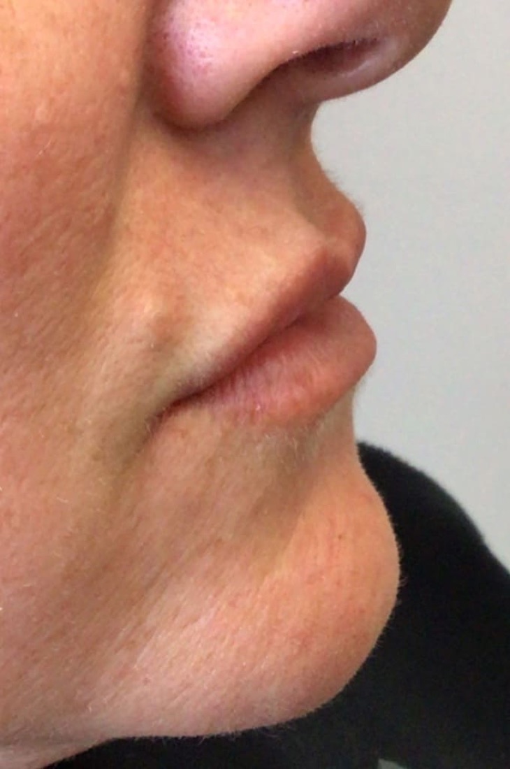 Before — Lip Filler — 2 Syringes at NeoMed Spa in Temecula, CA