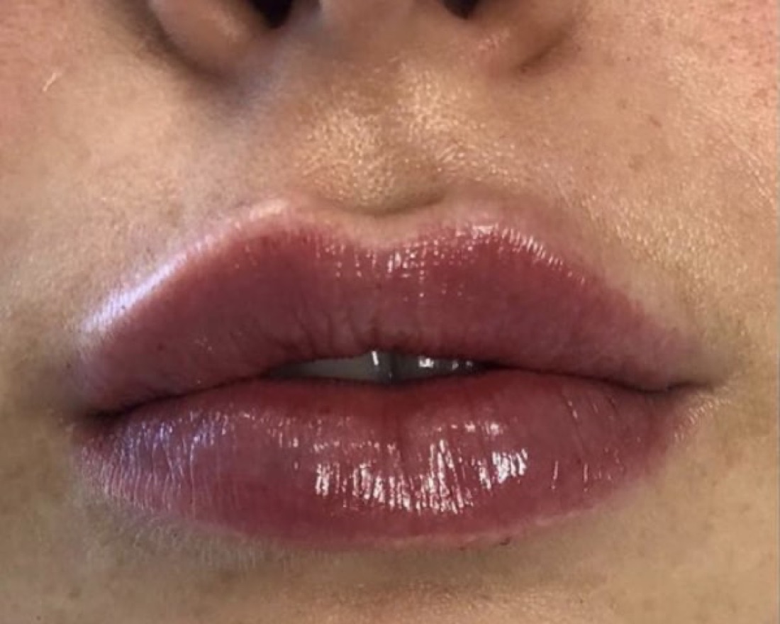 After — Lip Filler at NeoMed Spa in Temecula, CA