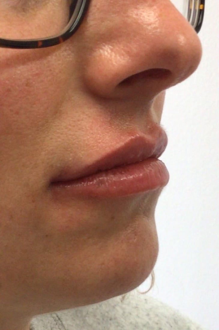 After — Lip Filler at NeoMed Spa in Temecula, CA