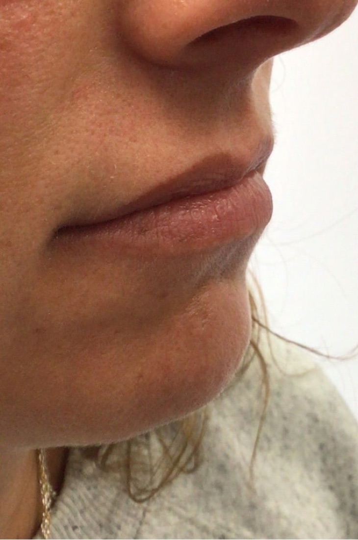Before — Lip Filler at NeoMed Spa in Temecula, CA