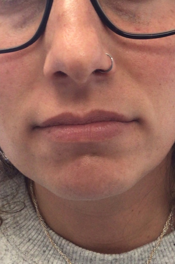 Before — Lip Filler at NeoMed Spa in Temecula, CA