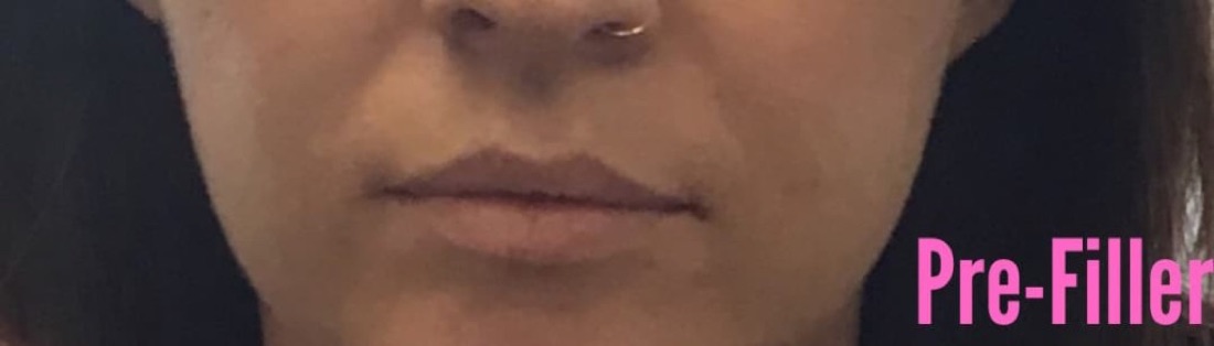 Before — Restylane Lip Filler at NeoMed Spa in Temecula, CA