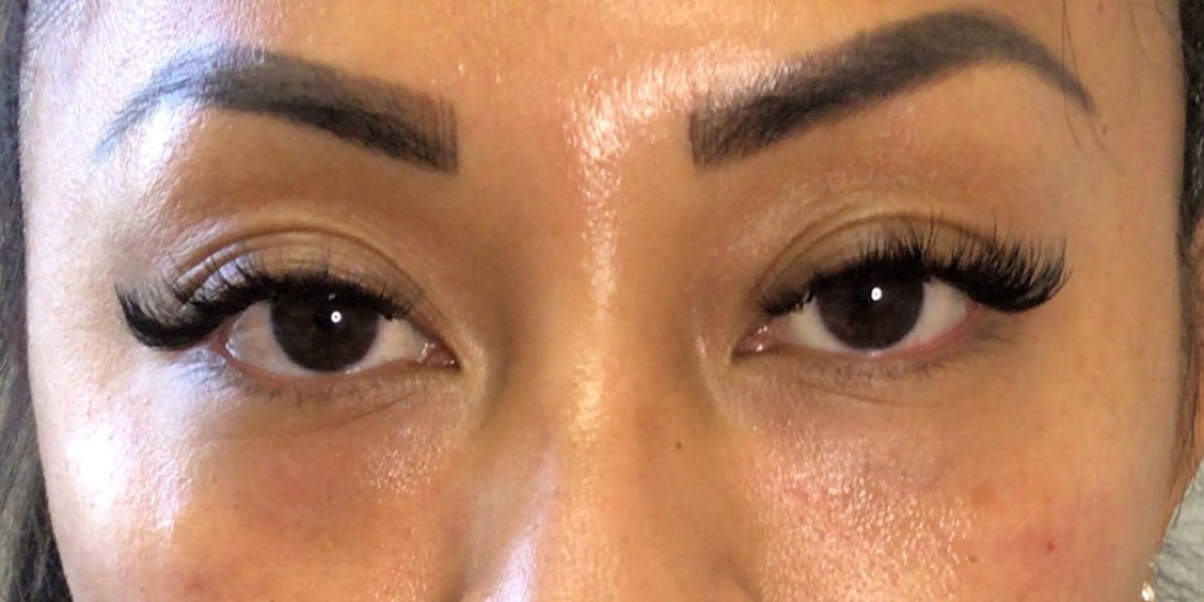 After — Tear Trough Filler — Belotero at NeoMed Spa in Temecula, CA