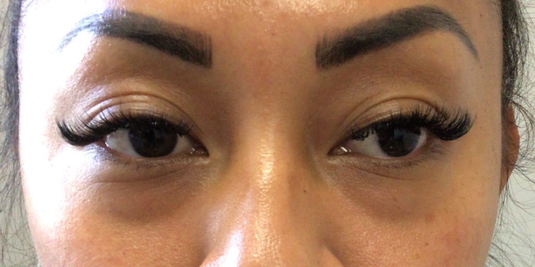 Before — Tear Trough Filler — Belotero at NeoMed Spa in Temecula, CA
