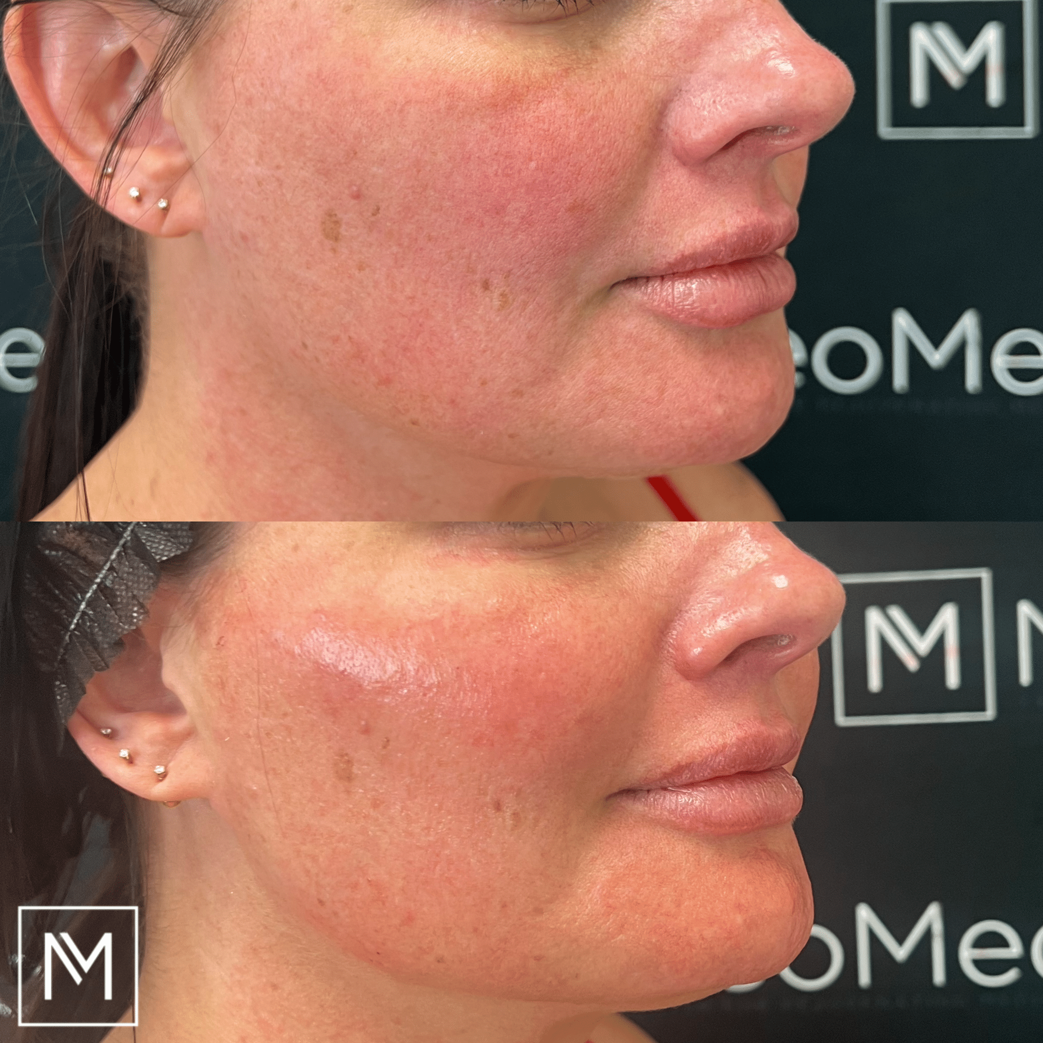 Before and After Image: Dermal Filler - right-front-oblique