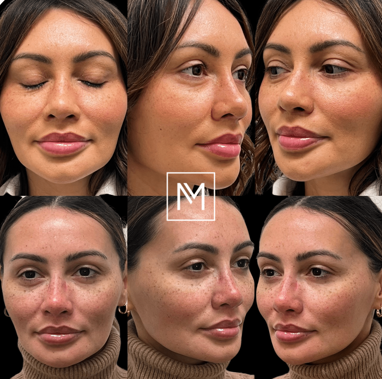 Before and After Image: Dermal Filler - front