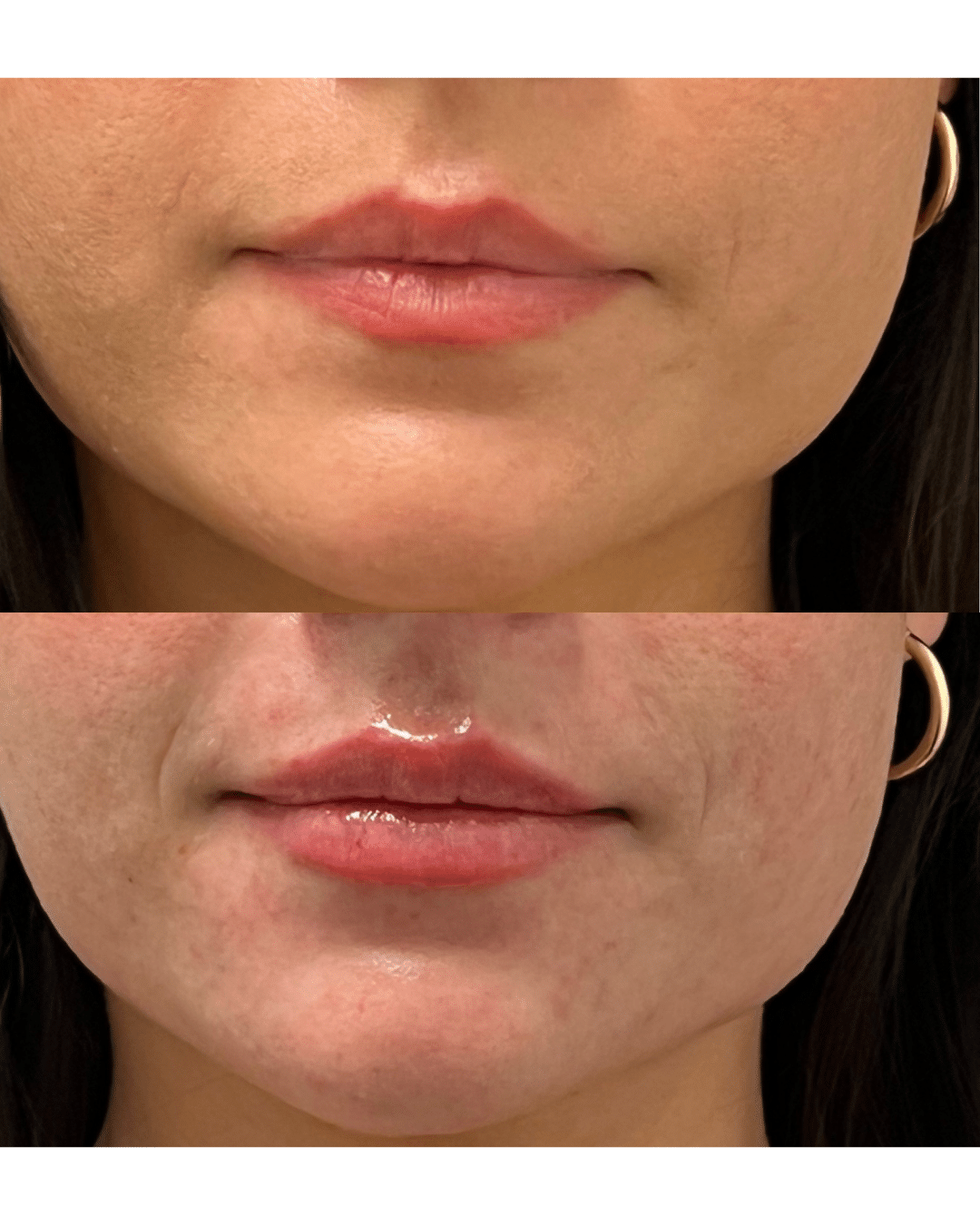 Before and After Image: Lip Filler - front