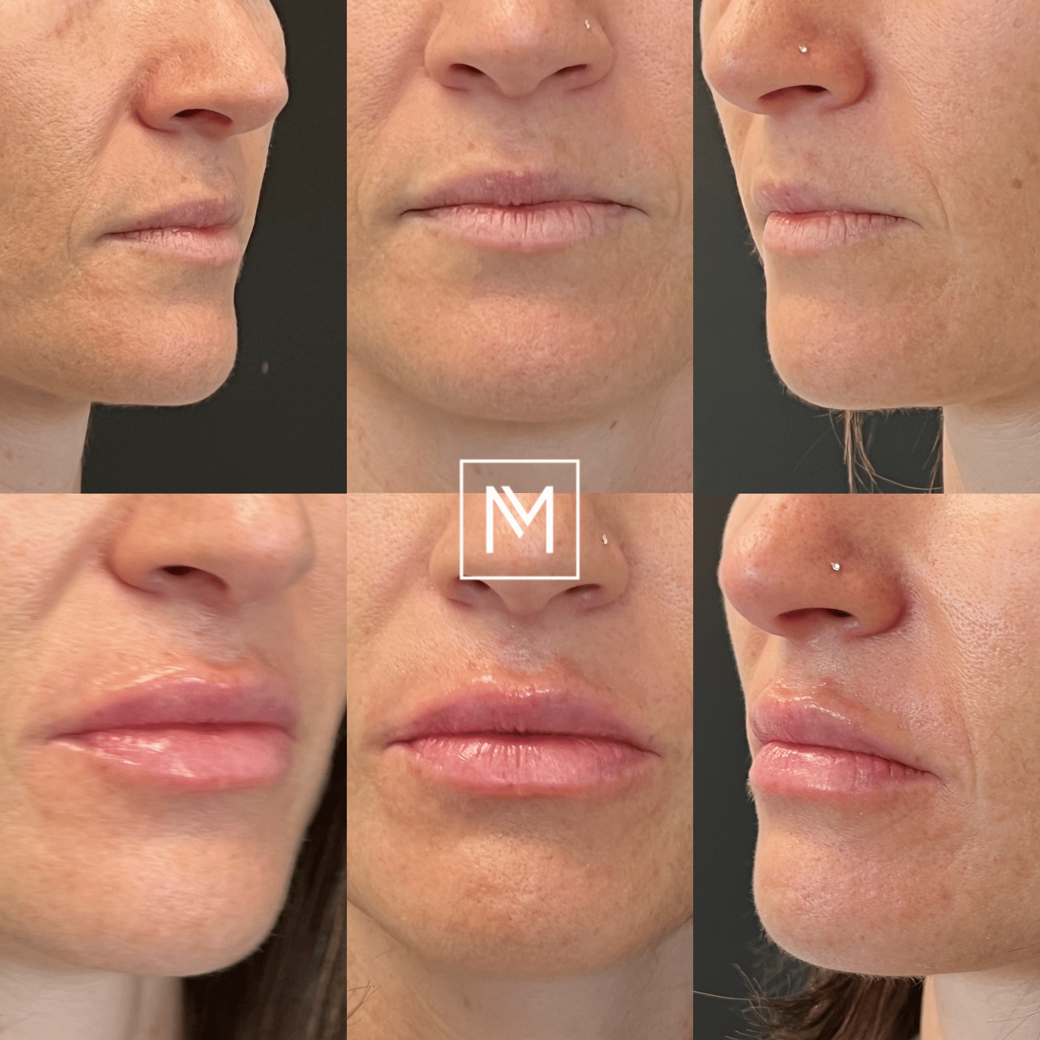 Before and After Image: Lip Filler - front