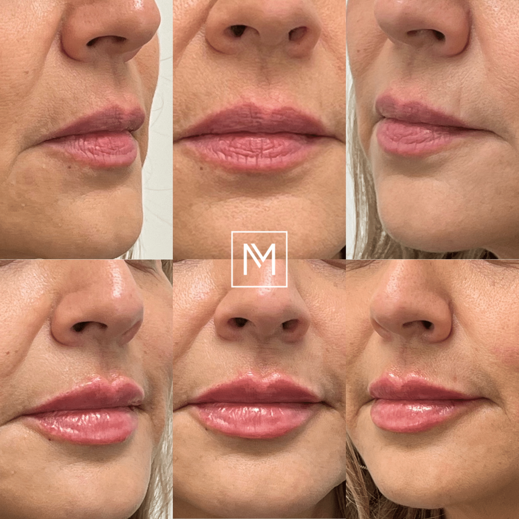 Before and After Image: Lip Filler - front