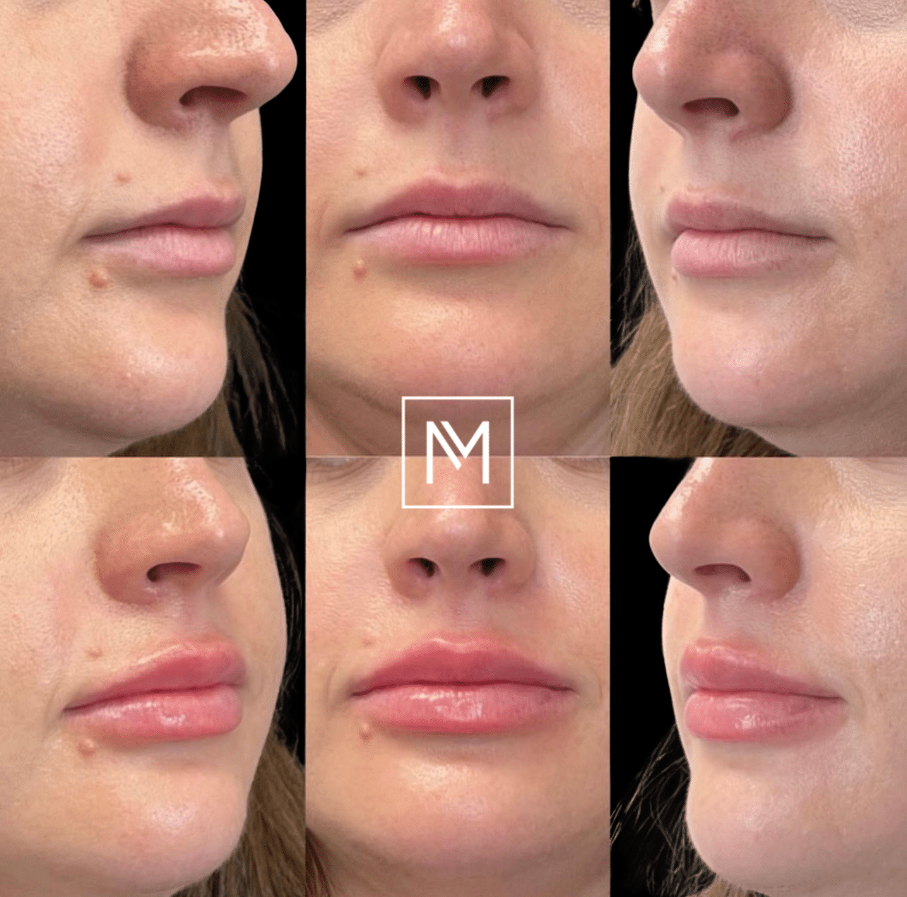 Before and After Image: Lip Filler - front