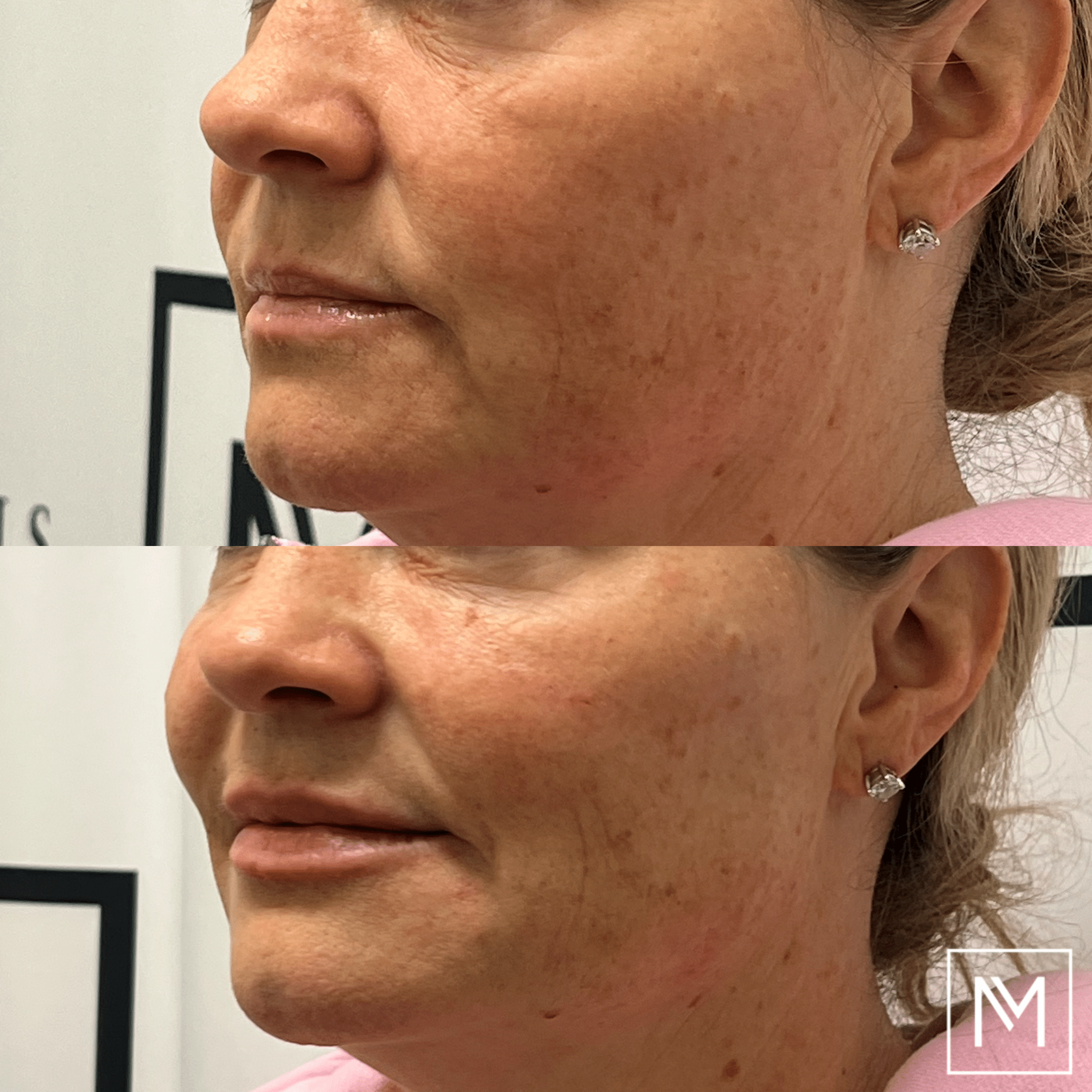 Before and After Image: Lip Filler - left-front-oblique