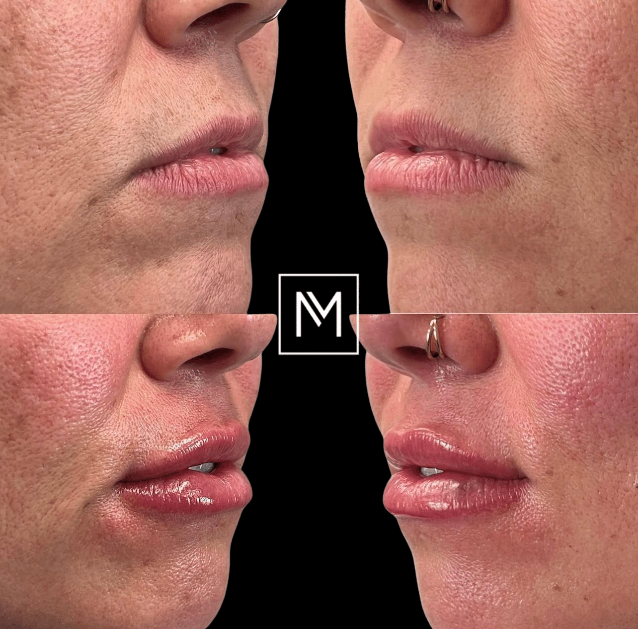 Before and After Image: Lip Filler - front