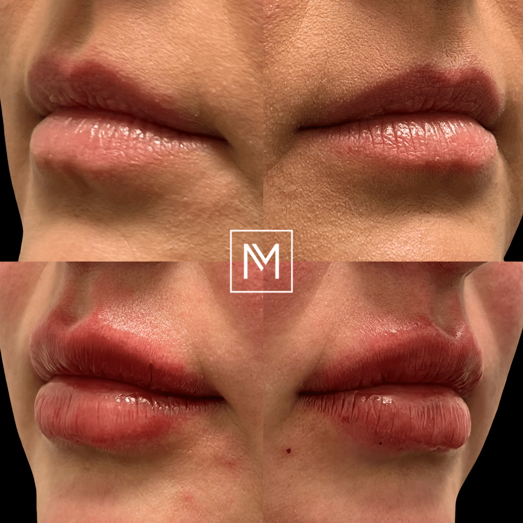 Before and After Image: Lip Filler - front