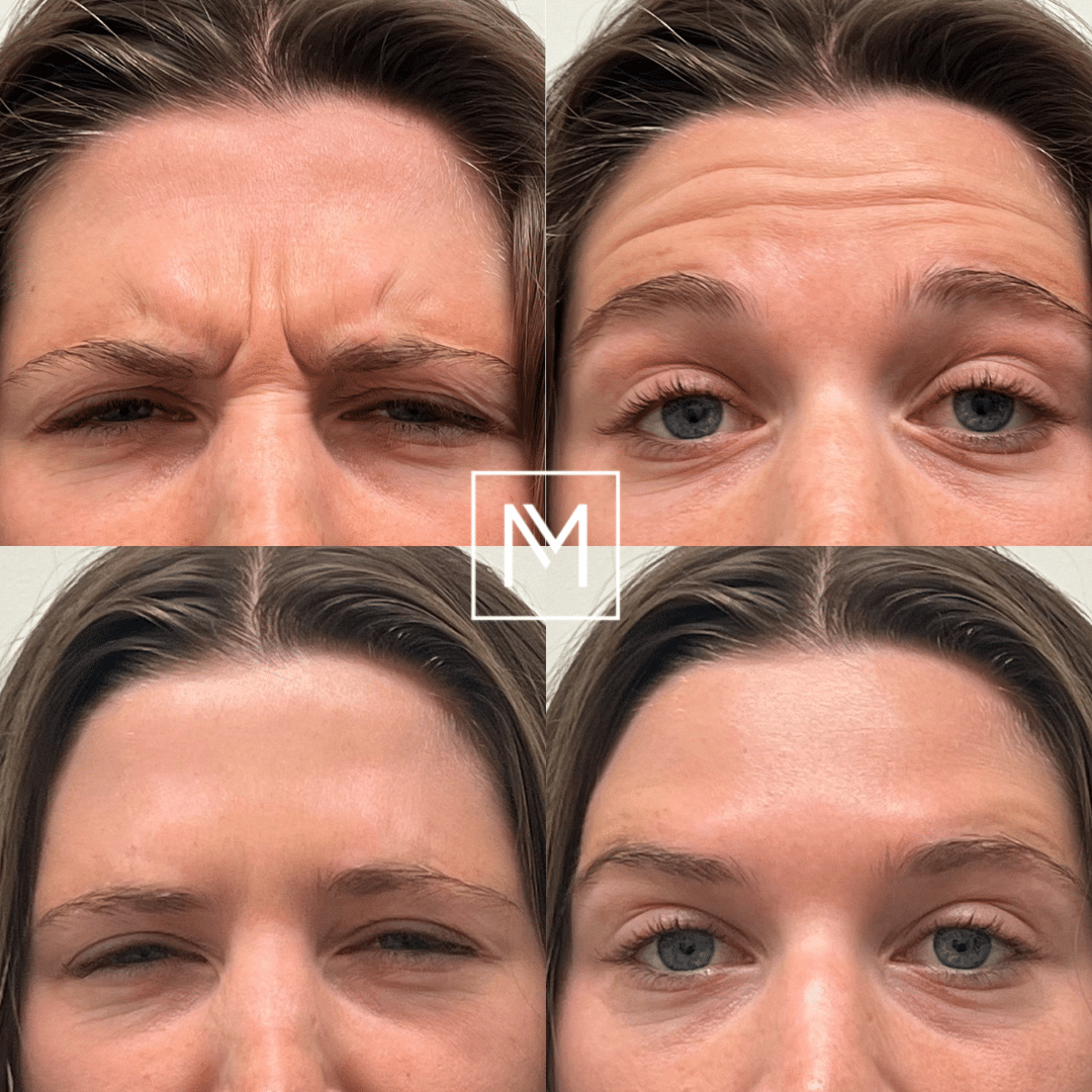Before and After Image: Neurotoxin - front