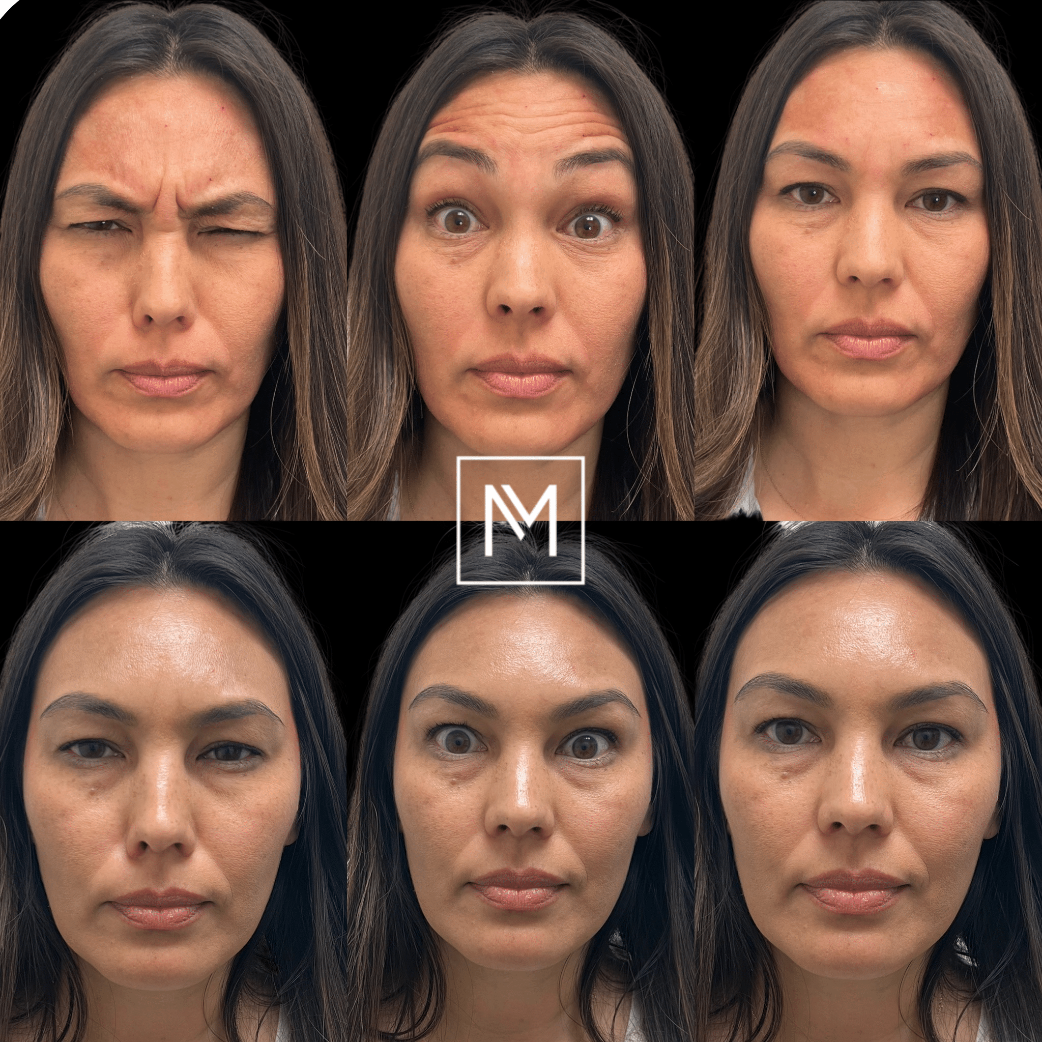 Before and After Image: Neurotoxin - front