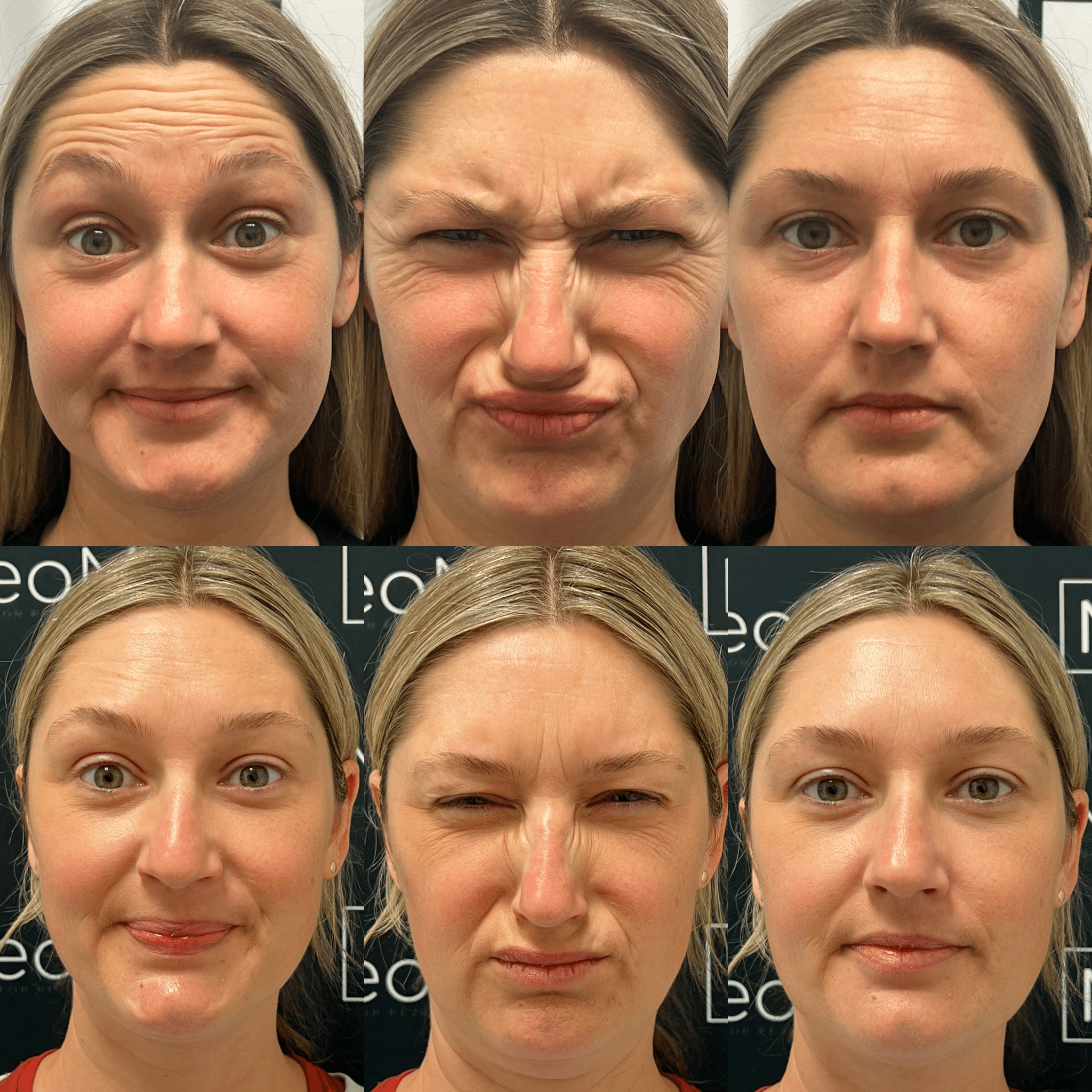 Before and After Image: Neurotoxin - front
