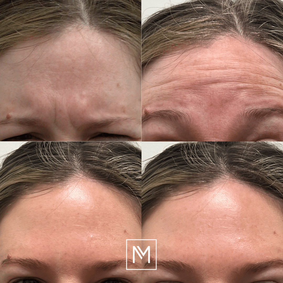 Before and After Image: Neurotoxin - front