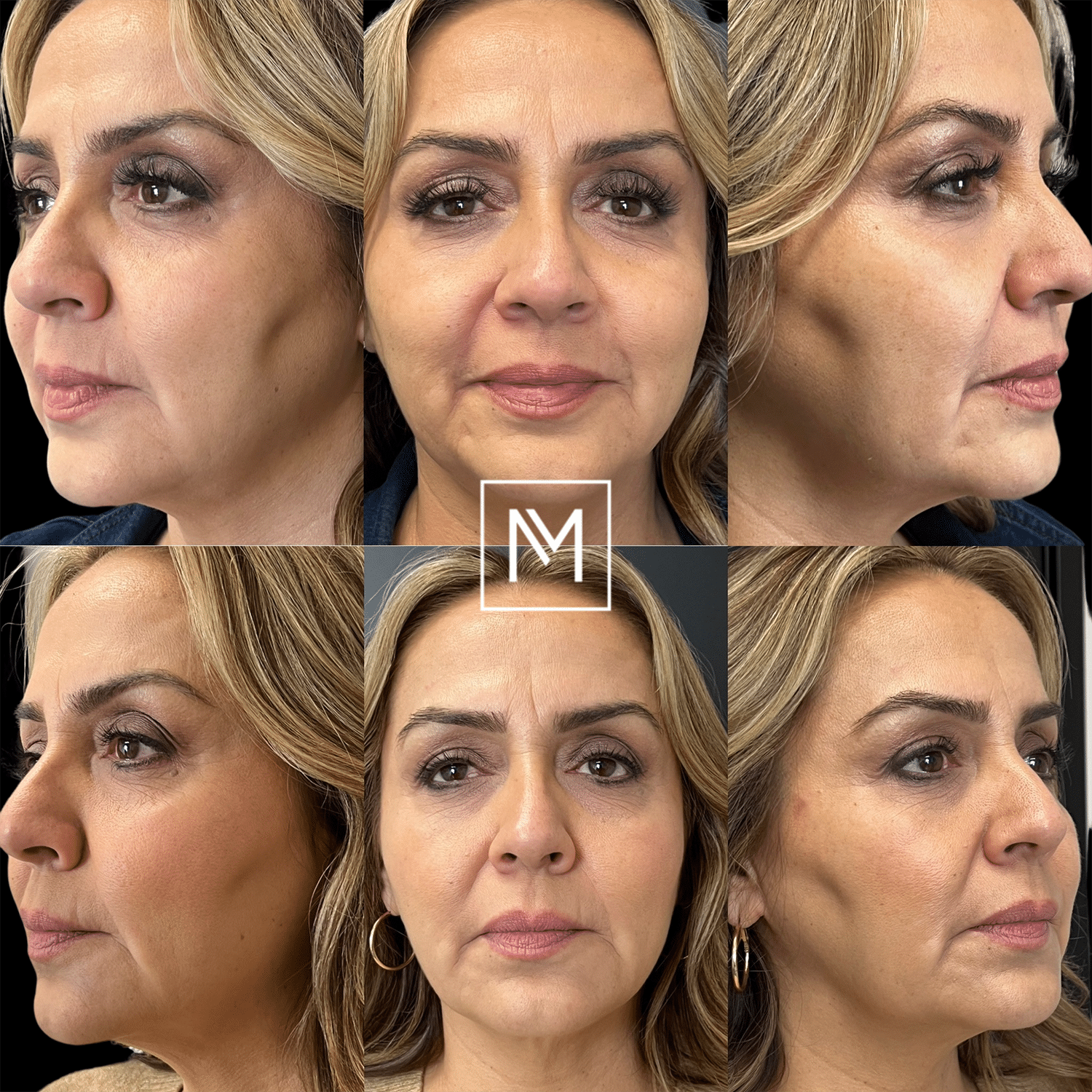 Before and After Image: Botox and Dermal Fillers - front
